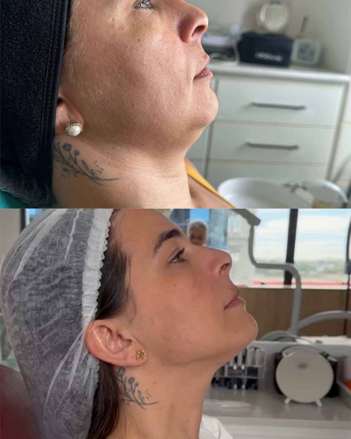 Resultado de contorno facial antes e depois