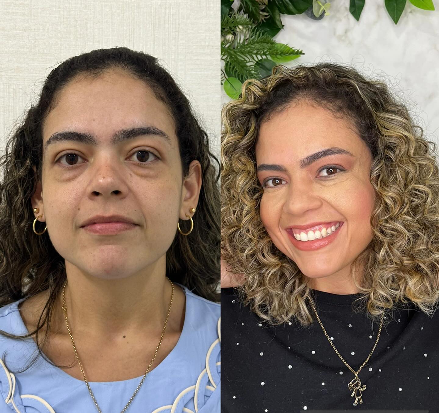 Resultado antes e depois de paciente da Dra. Paula Brasil